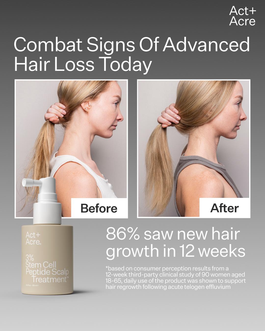 thumbnail-act-hair-density-in-90-days-0