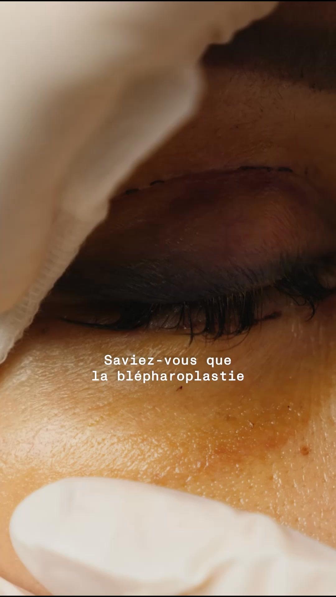 thumbnail-aloe-blepharoplastie-vs-patchs-0